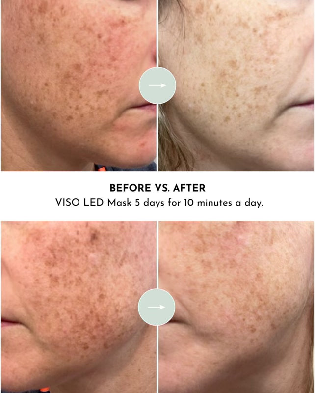 LUMARA VISO - FDA Certified Red Light Therapy Mask Lumara