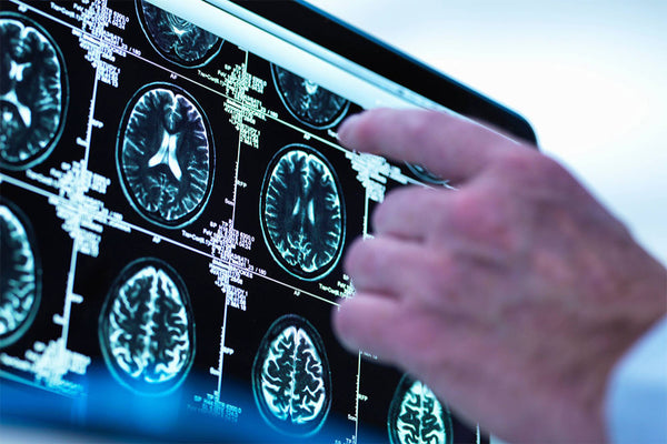 Brain scans reveal structural changes during menopause that could explain higher dementia rates in women